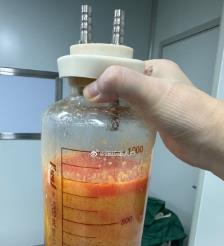 长岭水动力吸脂手术要做多久？